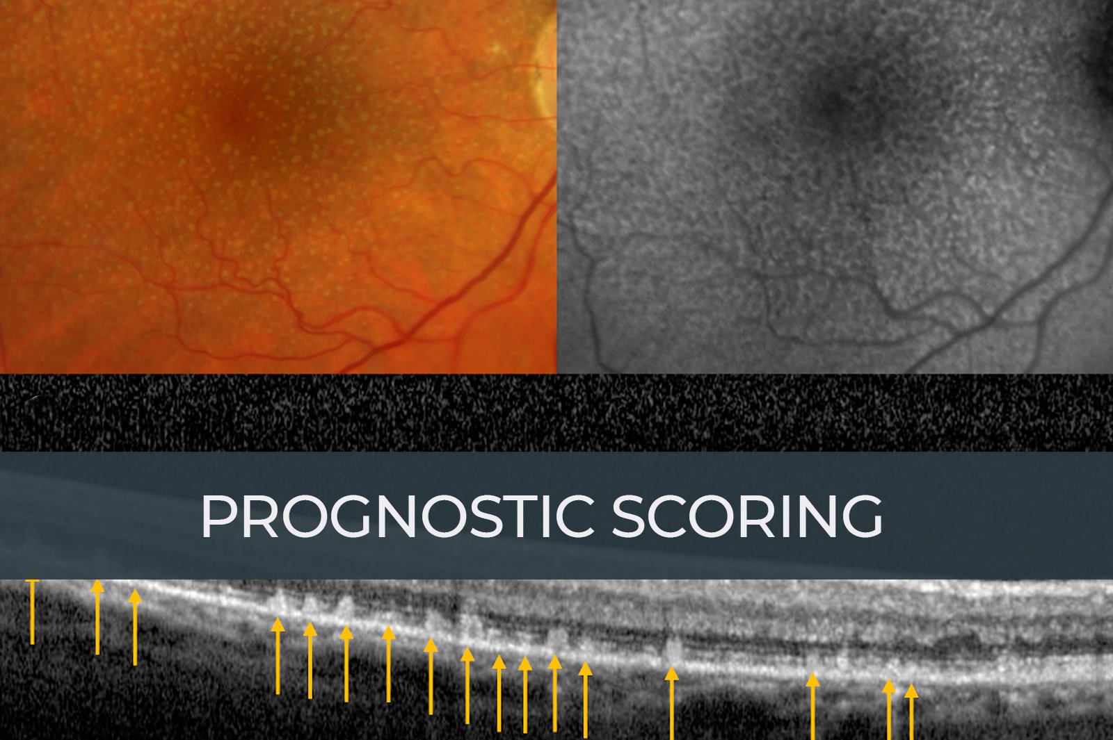 https://retinaimagingcongress.com/wp-content/uploads/2025/05/prognostic-scoring.jpg